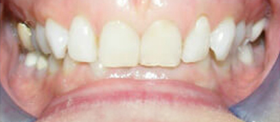 Teath Before Teath Before
