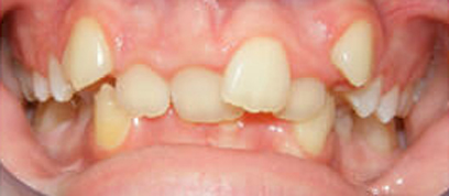 Teath Before Teath Before