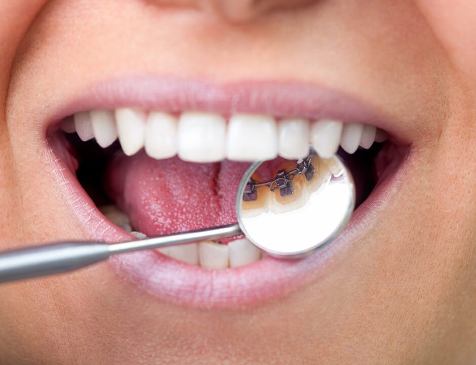 lingual-braces lingual-braces