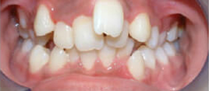 Teath Before Teath Before