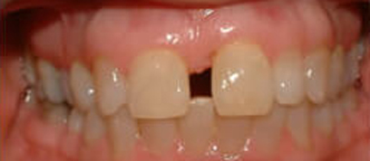 Teath Before Teath Before