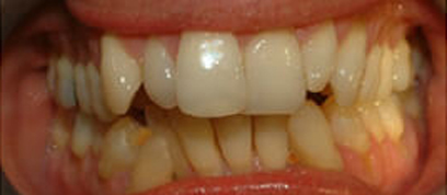 Teath Before Teath Before